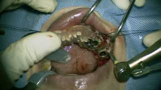 Straumann NC RN WN place in posterior mandible 2 [upl. by Stilla]