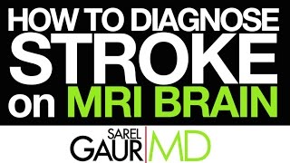 How to Diagnose Stroke on MRI Brain [upl. by Amzaj]