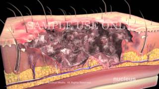 Burns Classification and Treatment [upl. by Gruver]