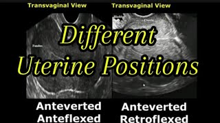 Uterine Positions In Ultrasound  AntevertedRetroverted  AnteflexedRetroflexed Uterus [upl. by Veno]