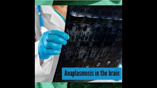 Anaplasmosis causes neurologic problems [upl. by Gautea]