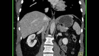 Abdomen Liver Hemangioma of the Liver6 of 8 [upl. by Farnham]