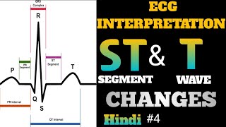 ECG interpretation in hindi  how to read ecg in hindi  ST and T Wave Changes interpretation  4 [upl. by Bolen]