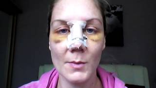 Septoplasty Recovery  Day 5 revision surgery [upl. by Adnamaa472]