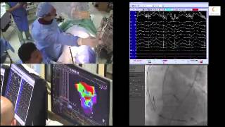 VT ablation with 3D electro anatomical mapping in a patient with VT storm and multiple CRTD shocks [upl. by Locklin]