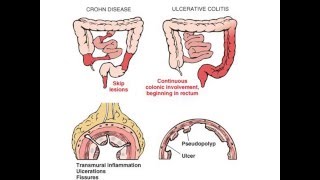 GASTROENTEROLOGIE pathologie intestinale 2015 [upl. by Nortyad631]