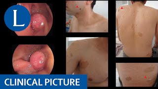 Neurofibromatosis type 1 and a gastrointestinal tumour [upl. by Kung]