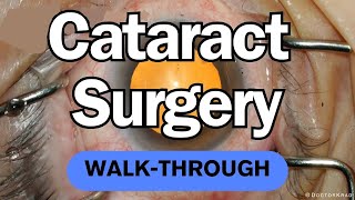 CATARACT SURGERY for Beginners  WalkThru of Manual Cataract Surgery with Basic Monofocal Eyhance [upl. by Ailen]