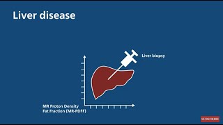 Philips Ultrasound Liver Fat Quantification Value Proposition [upl. by Akinar]