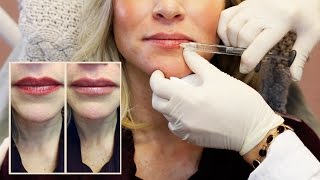 30 Units of Botox  Lip Filler from Doctor Cynthia Cote [upl. by Phineas]