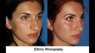 Ethnic Rhinoplasty Middle Eastern Versus Hispanic Nose [upl. by Elleinnod]