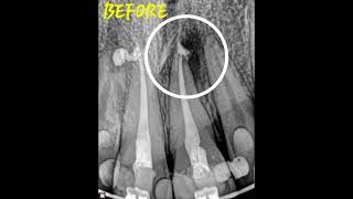 Healing of 2 periapical lesions in one patient [upl. by Ennayram988]