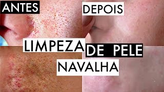 LIMPEZA DE PELE COM NAVALHA [upl. by Lexie874]