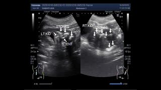 Ultrasound Video showing Pyonephrosis Parenchymal disease with bilateral multiple stones [upl. by Kowatch59]