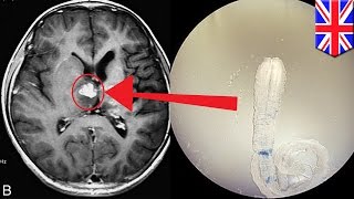 Tapeworm infection Rare brain worm took 4 years to crawl across UK man’s brain [upl. by Harwill187]