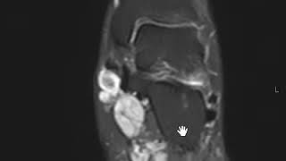 Plantar Fibromatosis [upl. by Ahseryt]