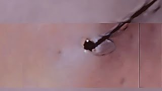 Removal of ingrown hair [upl. by Bausch736]