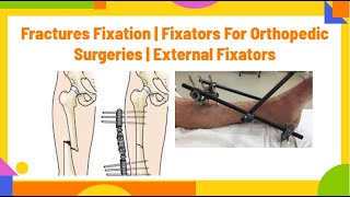 fractures fixation  fixators for orthopedic surgeries  external fixatorsPhysiotherapyKnowledge [upl. by Elyak]