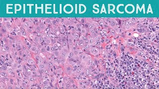 Epithelioid sarcoma explained in 5 minutes pathology dermpath dermatopathology dermatology [upl. by Elconin74]