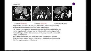15 6 EX SEGMENTATION HÉPATIQUE EXERCICES [upl. by Ramona]