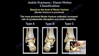 Ankle Fractures Danis Weber Classification  Everything You Need To Know  Dr Nabil Ebraheim [upl. by Piero]