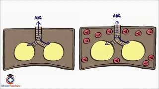 Pneumothorax and Tension Pneumothorax [upl. by Ahsenot]