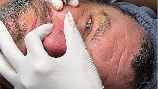 Acne Treatment Huong Da Nang Educational Video [upl. by Ralat]