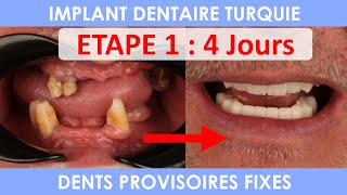 Implant dentaire en Turquie  Implantation bouche complète [upl. by Ashman]