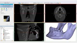 Orthognathics Part I PrePlanning  PROPLAN CMF™ [upl. by Damales]