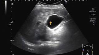 Ultrasound Video showing multiple hepatic Hemangiomas [upl. by Rehpotsihc]