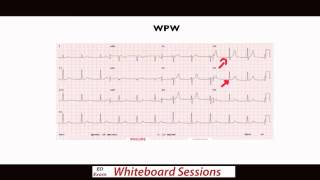 EDExam Whiteboard Session Dont Miss These ECGs Part 1 [upl. by Hayidah]