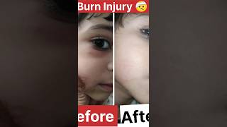 Burn InjuryScar freeBurn waterSkin care diseases dermatologist burninjuries burn shorts [upl. by Eenimod]