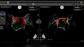 atrialfibrillation ablation cartonet EP Study Cardiology [upl. by Malachi136]