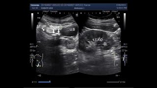 Ultrasound Video showing focusing and tracing of stones in ureter [upl. by Duj]