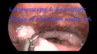 Laryngoscopy amp Endoscopic Biopsy of Neoplasm under LA [upl. by Ofloda]