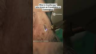 What is Cryotherapy also known as Cryoablation or Cryosurgery [upl. by Oelak]