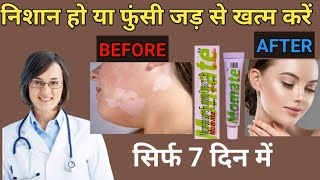 momate cream use in hindi mometasone cream [upl. by Kimitri]