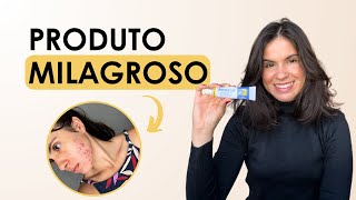 Como tratar acne com peroxido de benzoila  minha experiência com fotos [upl. by Eirahs]