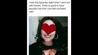 Trichotillomania Hair Regrowth Testimony [upl. by Allare]