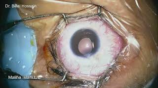 Movement of subluxated SFIOL [upl. by Kareem]