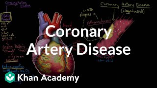 What is coronary artery disease  Circulatory System and Disease  NCLEXRN  Khan Academy [upl. by Elleimac]