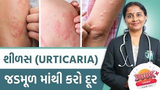 Ayurvedic Treatment Of Urticaria  Dr Devangi Jogal  JOGI Ayurved [upl. by Relyt]