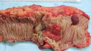 Learn About Internal Hemorrhoids [upl. by Correy]