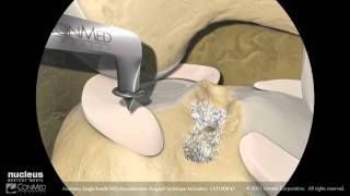 ConMed Single Bundle ACL Reconstruction [upl. by Esened]