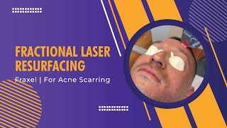 Fractional Laser Resurfacing  Fraxel  For Acne Scarring  Dr Jason Emer [upl. by Morris]