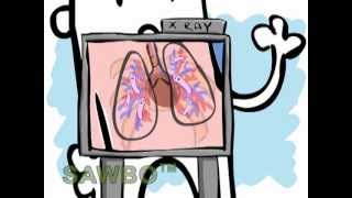 Tuberculosis Prevention in English accent from the USA [upl. by Vange]