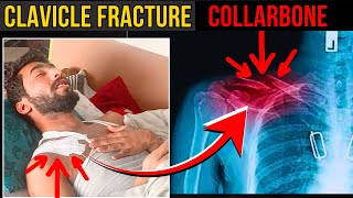 clavicle fracture  collarbone fracture  clavicle fracture natural healing [upl. by Chew]