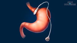 Tout savoir sur la pose dun anneau gastrique [upl. by Maleki]