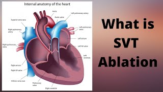 What is SVT Ablation [upl. by Anawal]