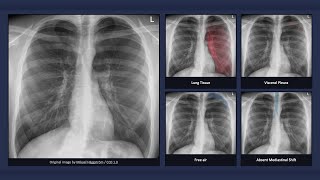 Simple Pneumothorax Explanation of Chest Xray Findings [upl. by Mosora]